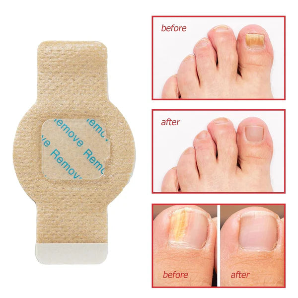 2X1 PARCHE UÑAS ANTIHONGOS