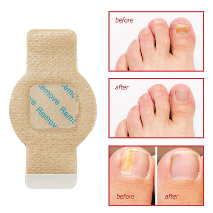 2X1 PARCHE UÑAS ANTIHONGOS